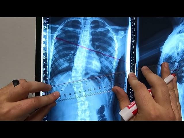 How To Measure Scoliosis Cobb Angle Without Complex Tools