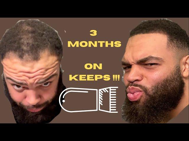 Keeps Hair Loss Review #finasteride #keeps #minoxidil