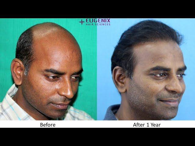 Hair Transplant Clinic in Delhi NCR (Gurgaon)- Eugenix Hair Sciences