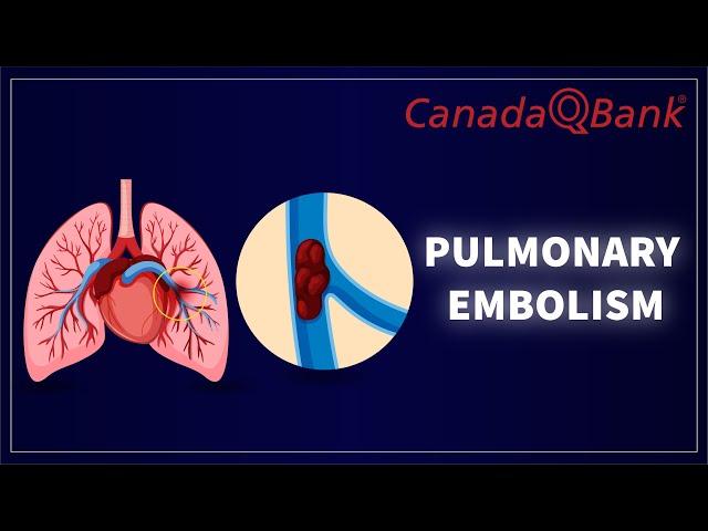 Pulmonary Embolism