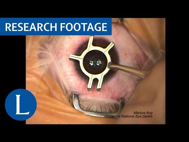 Surgical video: Femtosecond LASIK procedure. Video 1 of 2