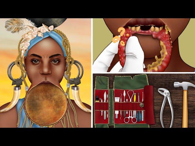 ASMR Pimple popping lip plates for the Mursi tribes woman | Treatment animation