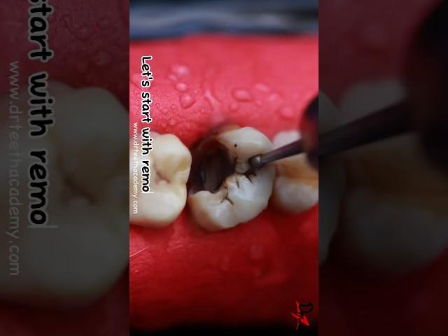 How is Root Canal Treatment (RCT) done? #dentist #rct