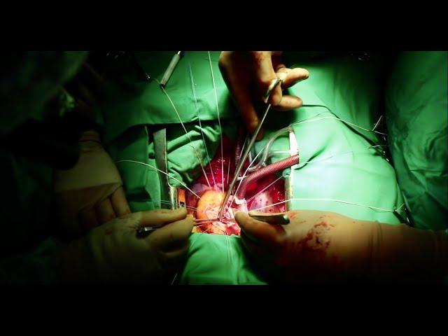 Open Heart Surgery: Aortic Valve Replacement from a Medical Student’s Perspective