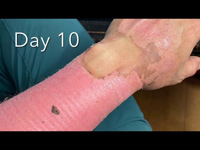 Healing Progress Of Second Degree Burns