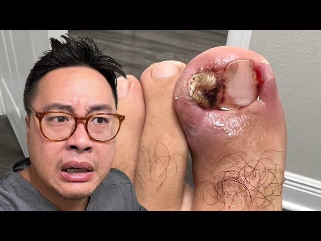 IS THIS THE WORSE INGROWN YOU EVER SEEN?