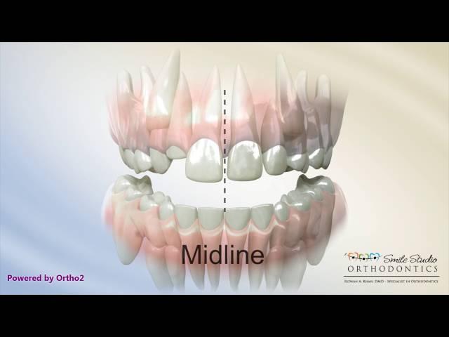 Midline Shift Due to Blocked Out Teeth - Orthodontic Treatment