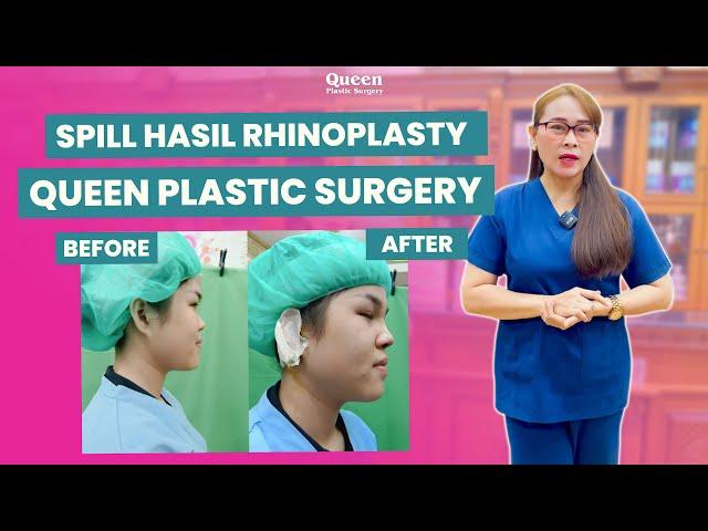 Spill Hasil Rhinoplasty Di Klinik Bedah Plastik Queen, Hidung Impian Jadi Nyata? | MUST WATCH