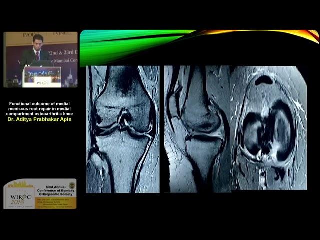 Functional outcome of medial meniscus root repair in medial ...- Dr. Aditya Prabhakar Apte