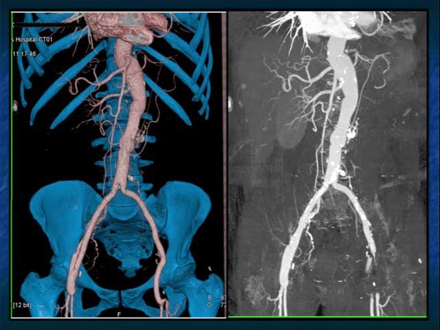 CTA of the Renal Arteries: What You Need to Know - Part 1