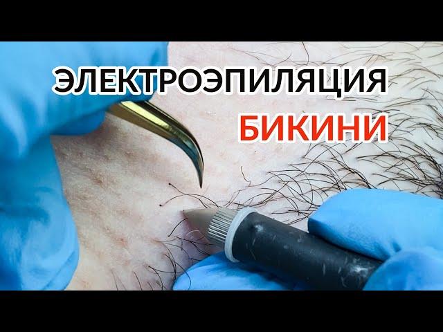 Электроэпиляция бикини - процесс / Electrolysis / електроепіляція