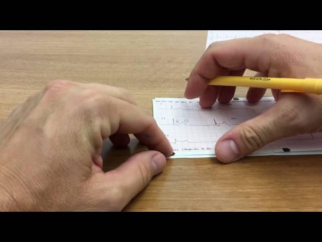 Introduction to the XII Lead ECG IV