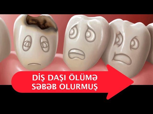 Diş daşı ölümə səbəb olurmuş