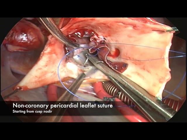 Aortic Valve Reconstruction with Ozaki Neo-Cuspidization in Unicuspid Disease