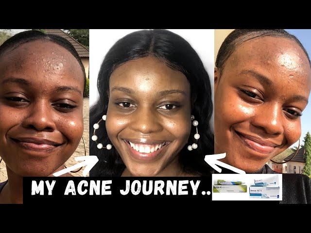 HOW I GOT RID OF MY ACNE USING TRETINOIN /RETIN-A AND BENZOYL PEROXIDE | MY ACNE JOURNEY