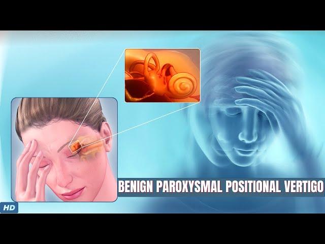 Benign Paroxysmal Positional Vertigo: What You Need To Know