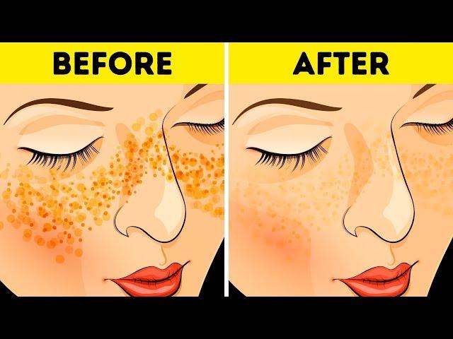 How to Get Rid of Acne Scars In Just 3 Days