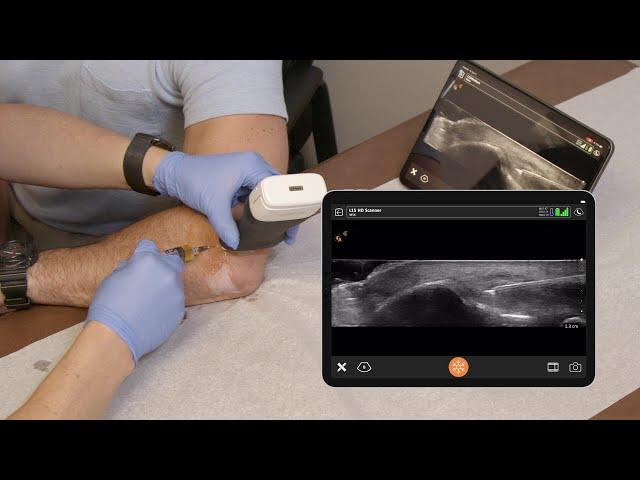 Lateral Epicondyle Injection - Ultrasound Scanning Technique