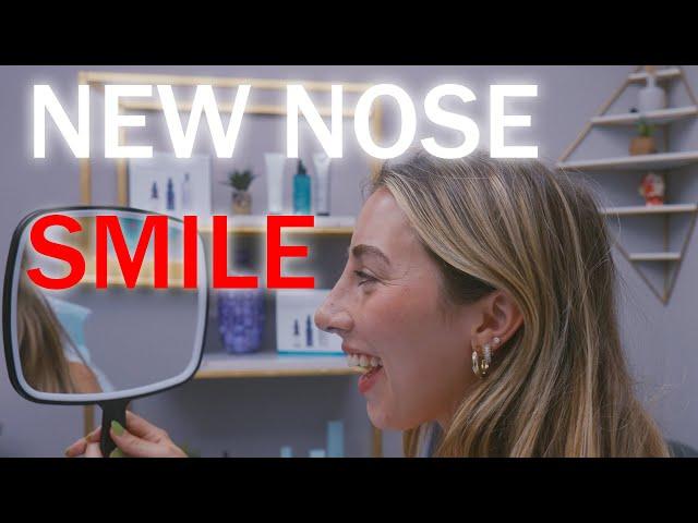 Stunning Rhinoplasty Makeover: A Life-Changing Journey with Dr. Caridi