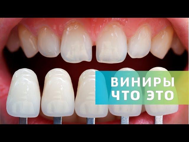 Виниры. Зачем, когда и где устанавливать | Что такое виниры | Дентал ТВ