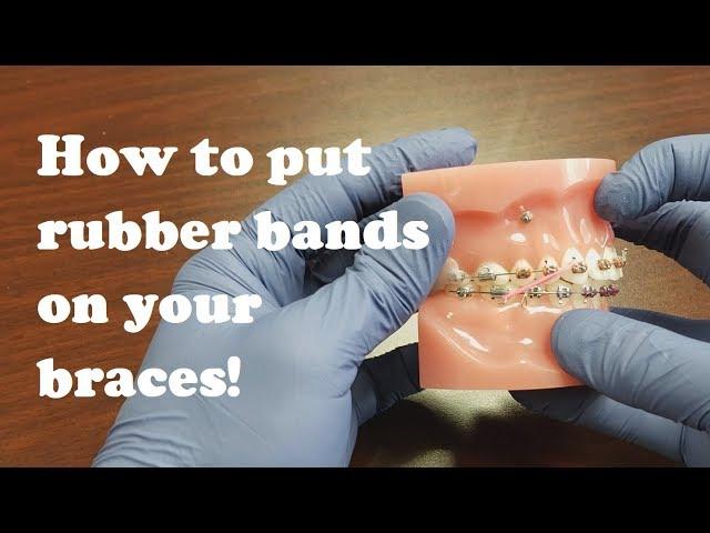 Tutorial: How to put rubber bands on your braces