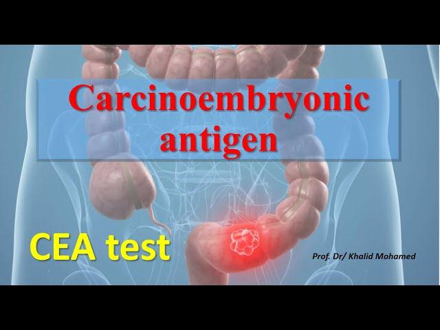 Carcinoembryonic antigen (CEA) test