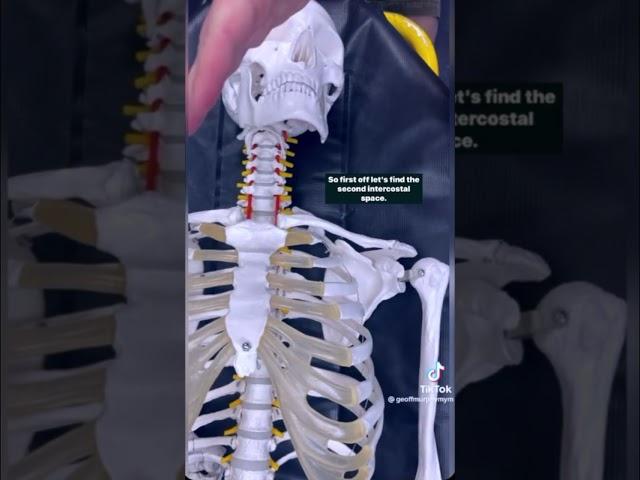 Decompressing a Tension Pneumothorax