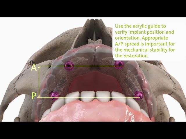 Straumann® ProArch with BLX Implant System