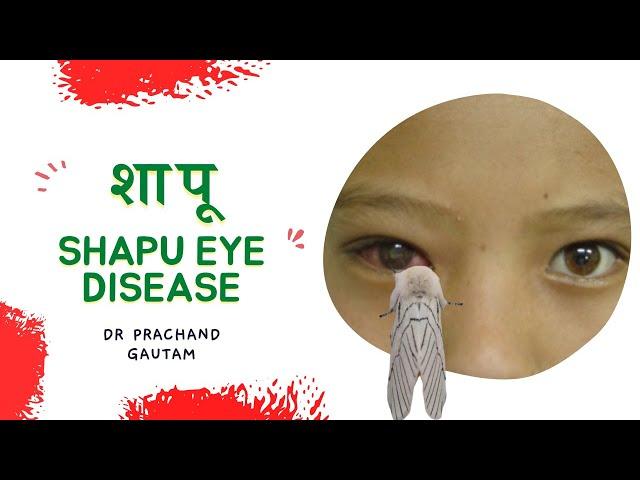 SHAPU EYE DISEASE