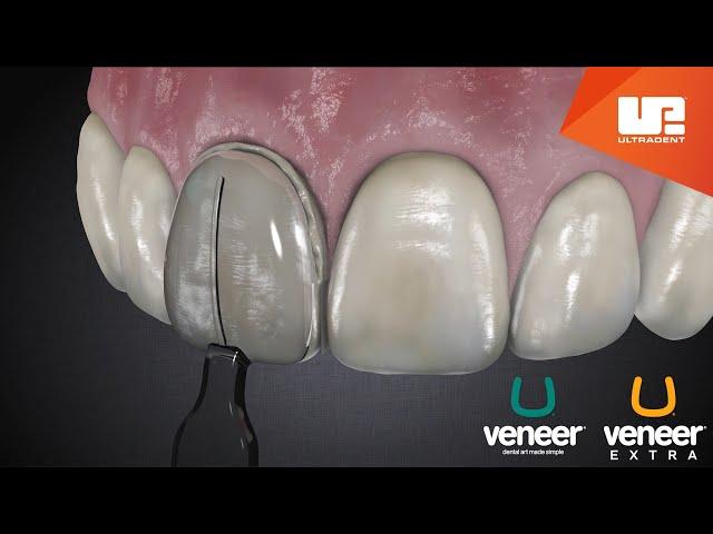 Uveneer® Procedure Animation | Direct Veneer Template System