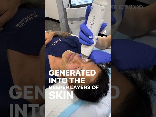 RF Micro-needling to regenerate Collagen