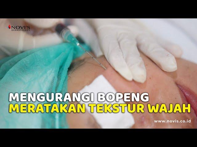 Atasi Bopeng Bekas Jerawat & Meratakan Tekstur Kulit || NOVI'S