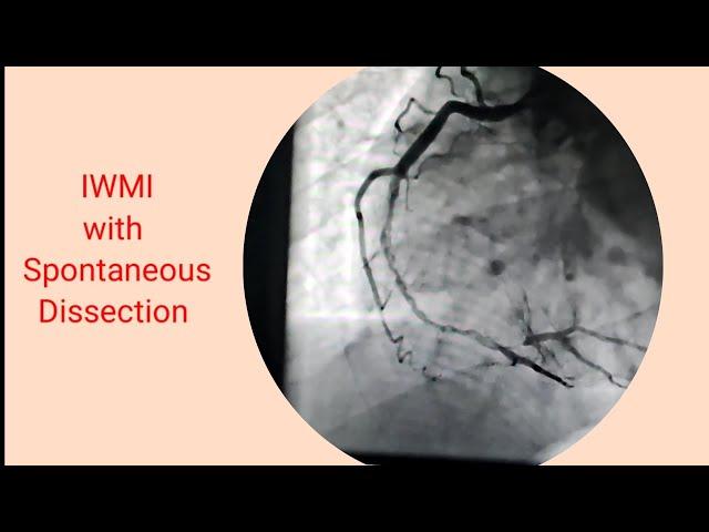 Heart attack(IWMI) with  dissection of RCA/ Stenting of RCA