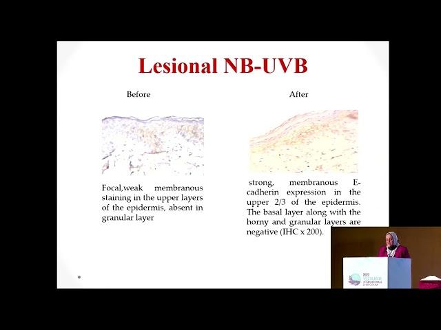 Combination of Acitretin and Narrowband UV-B for the Treatment of Vitiligo: