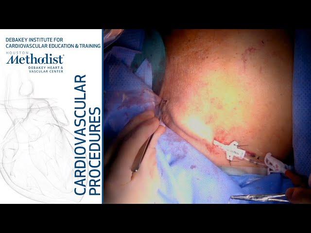 Tunneled Dialysis Catheter (TDC) Placement (Maham Rahimi, MD, and Kaled Diab, MD)