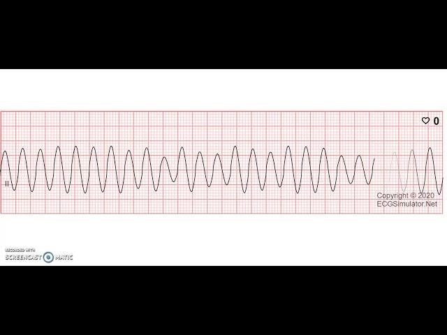 Ventricular Flutter