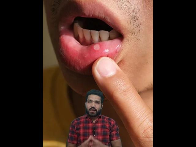 4 Home remedies for mouth ulcers! मुँह के छाले घर पर ठीक करें #shorts