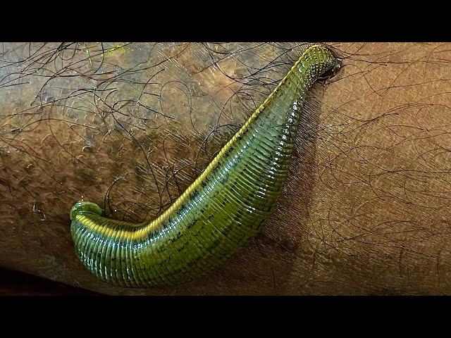 LEECH THERAPY #shorts #bloodpurification #ayurveda