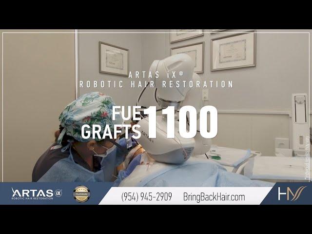 Hair By Dr. Max, Restoration Center - 1100 FUE Grafts ARTAS® Robotic Hair Restoration