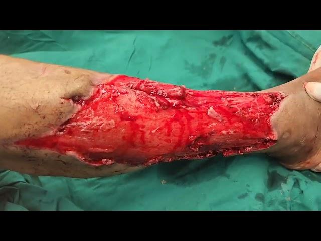 Diabetic foot: Debridement-Skin grafting