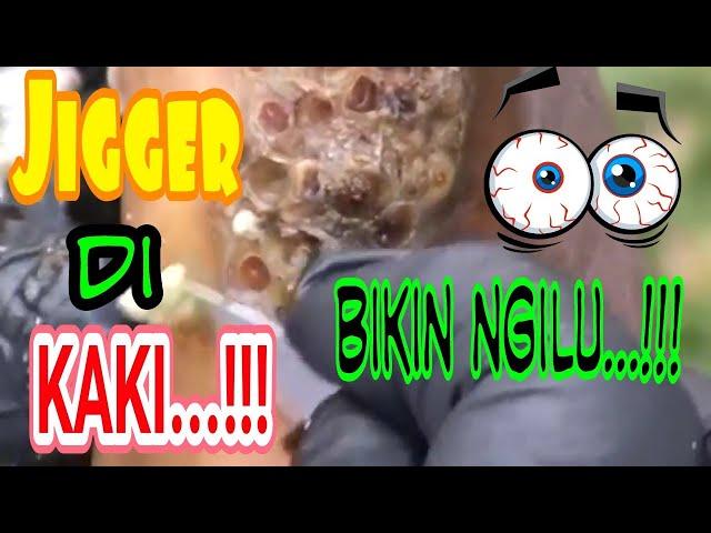 JIGGER/ larva lalat yg bersarang di kaki