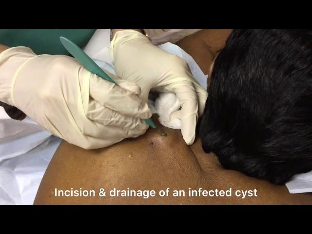 Incision and drainage of a large infected cyst