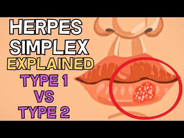 Herpes Simplex - Type 1 vs Type 2 - EXPLAINED IN 2 MINUTES