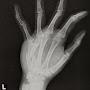 X-ray of my Hand