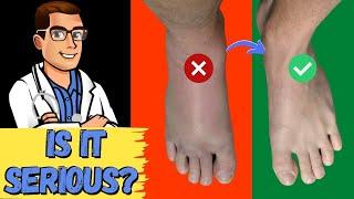 How To Tell If My Foot or Ankle Injury is BAD! [Sprained or BROKEN?]