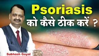 Psoriasis को कैसे ठीक करें ? Subhash Goyal | Sadhna TV