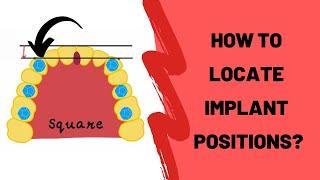 Implant Positions in Edentulous Maxilla | IMPLANTOLOGY