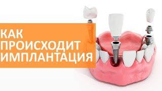  Основные этапы имплантации зубов | Семейный доктор