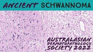 "Ancient" Schwannoma (benign degenerative nuclear atypia and pleomorphism) pathology dermpath