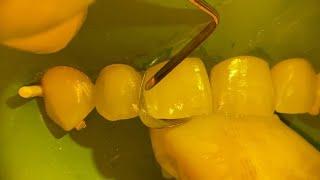 FAST & EASY way to close a tooth gap with composite